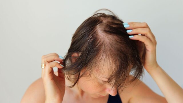 Strands of Strength: Navigating Hair Loss in Women and Discovering ...